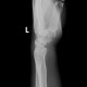 Fracture of scaphoid bone, dislocation of pisiform bone, abruption of lunate: X-ray - Plain radiograph